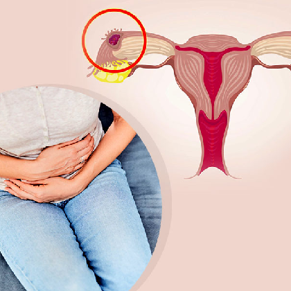 Ectopic Pregnancy symptoms