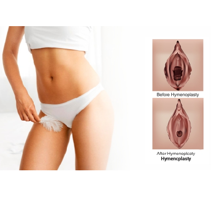 Hymenoplasty Symptoms