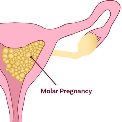 Molar Pregnancy Treatment