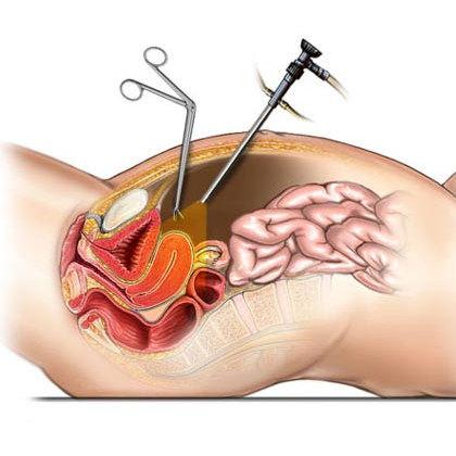 Uterus Removal Causes