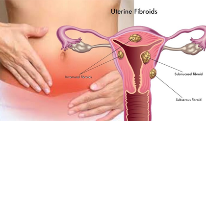 Uterus Removal Symptoms
