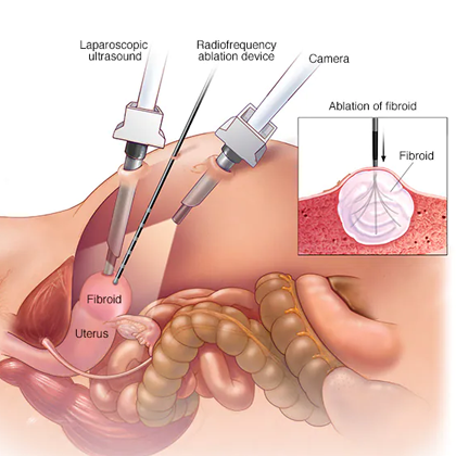 Uterus Removal Treatment