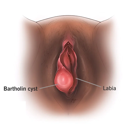 Vaginal Cyst Overview