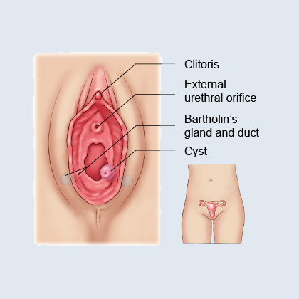 Vaginal Cyst Causes