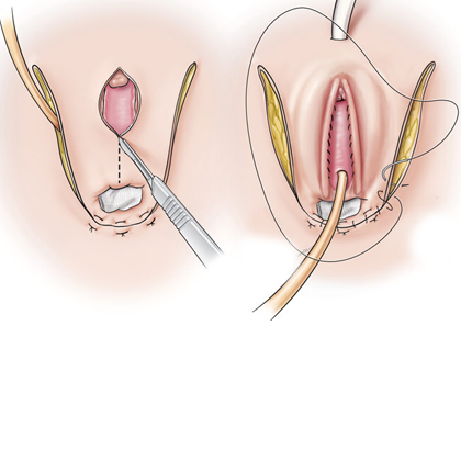 Vaginoplasty Overview