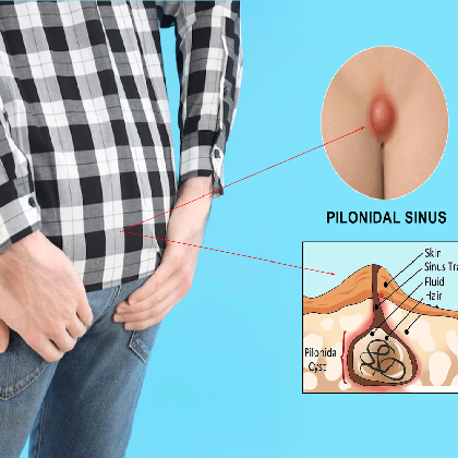 Pilonidal Sinus Causes