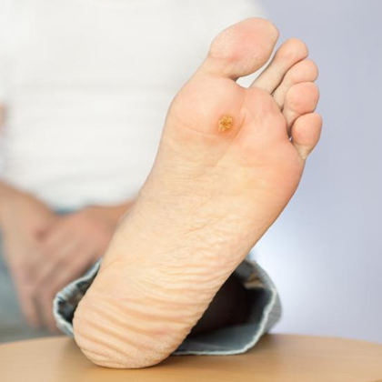 Diabetic Foot Ulcer Symptoms