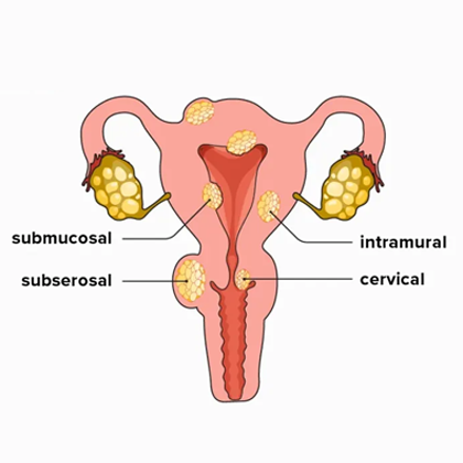 Uterine Fibroids symptoms
