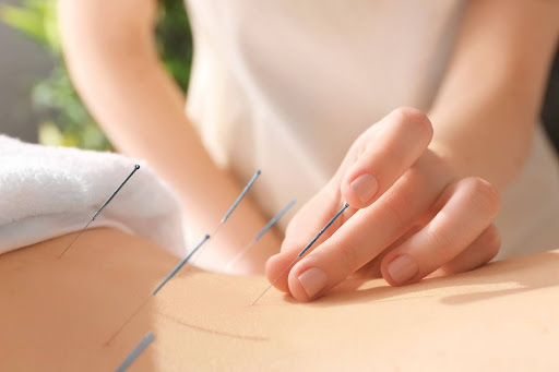 Doctor inserting acupuncture needles